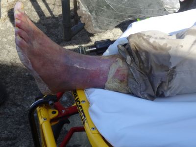 HS-0007
Photo Date: March 27, 2019
Photo Credit: Mark Linderman
Description: The photo is of a leg with skin falling off and body fluid leaking from wounds. The individual was trapped in a hoarded house for five days and was being attacked by raccoons at night. Animals were getting into the home due to large holes in the roof. 
